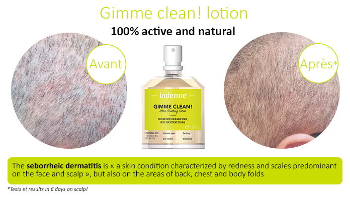 Gimme clean lotion natural to treat seborriheic dermatitis